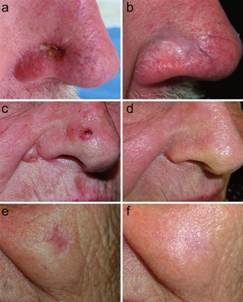 basaalcelcarcinoom dior plaspillen|Treating Basal Cell Carcinoma .